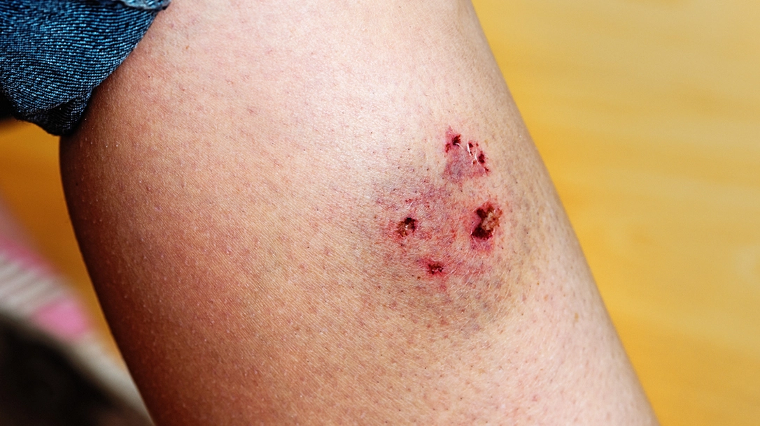 What You Need To Know About Animal Bites What You Need To Know About Animal Bites